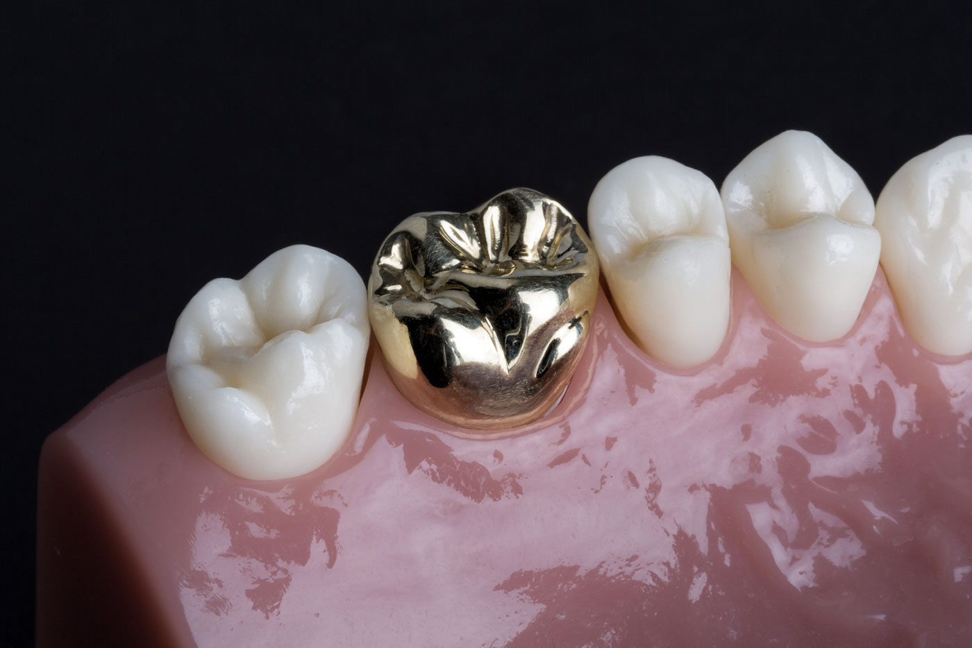 Couronnes dentaires céramiques (sans métal) : pose, type, sur pivot